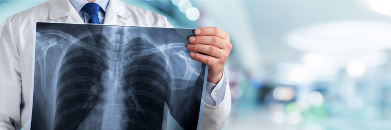 Cáncer de pulmón en Antofagasta